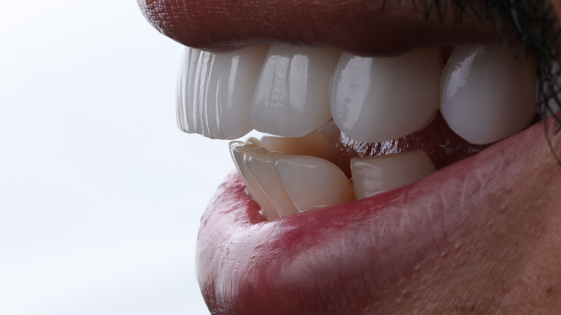 Detalle lateral de carillas de cerámica mostrando translucidez y borde incisal natural