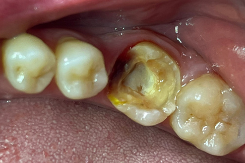 Fractura coronal inicial del diente 36