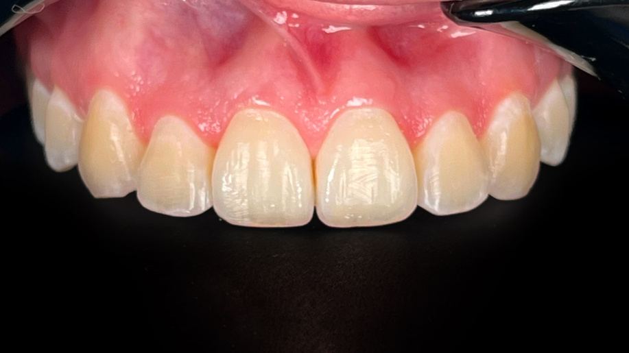 Tonalidad dental antes del protocolo mixto de blanqueamiento