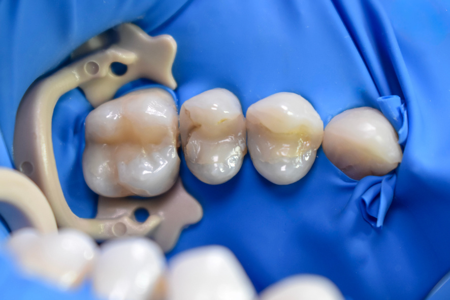 Caries secundaria inicial en el diente 15