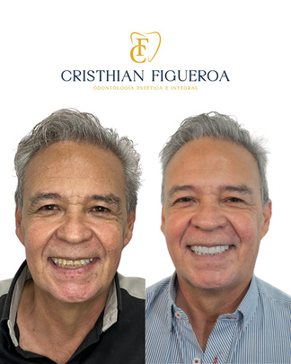Resultado del diseño de sonrisa con 17 unidades cerámicas
