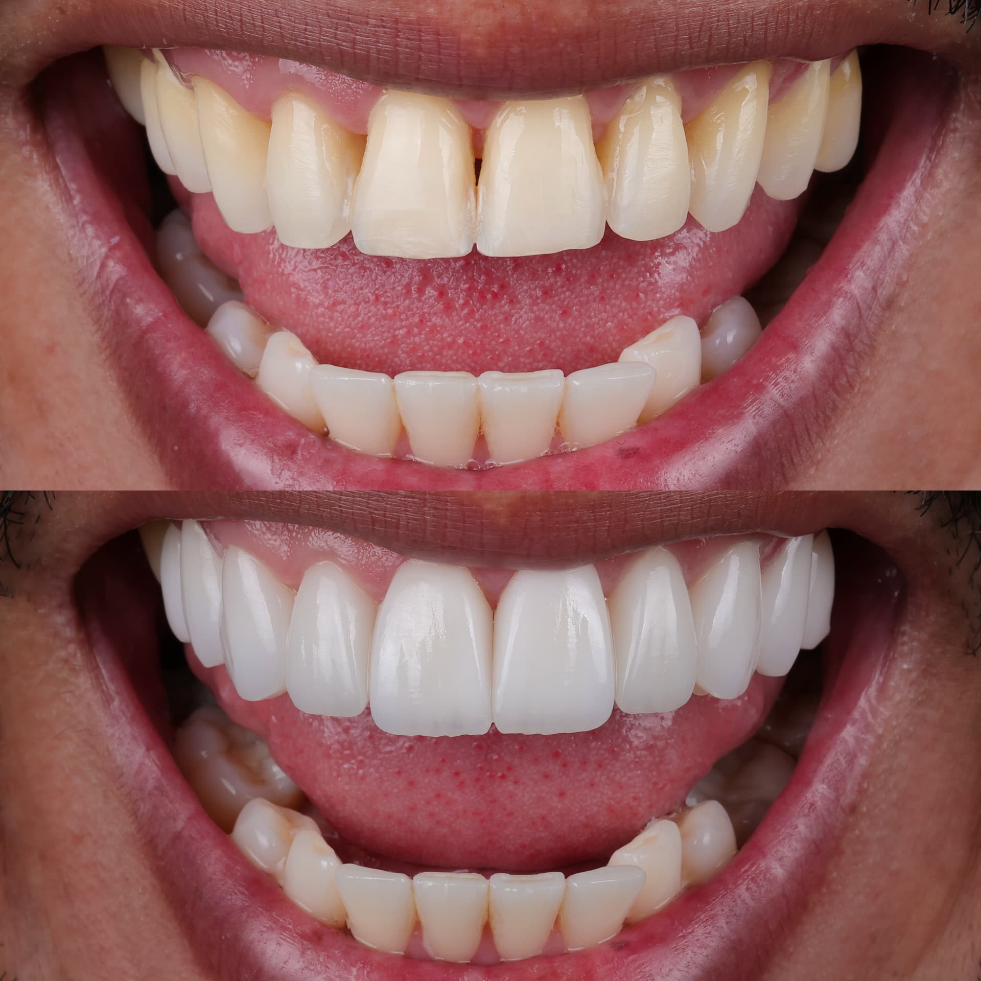 Antes y después de carillas en cerámica en Bucaramanga: dientes amarillentos y desalineados frente al resultado con porcelana