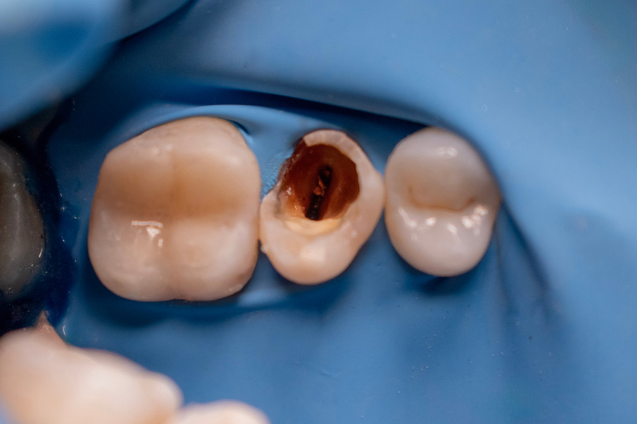 Preparación del diente después del manejo endodóntico y periodontal