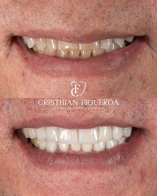 Situación inicial del caso de diseño de sonrisa con 17 lentes cerámicos