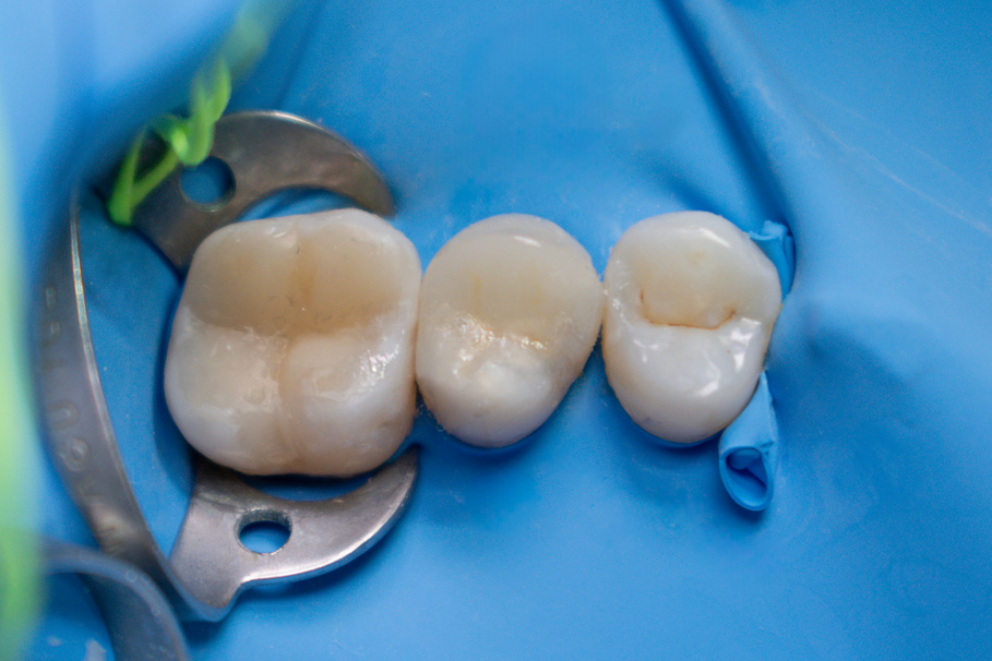 Reconstrucción biomimética y preparación para incrustación cerámica