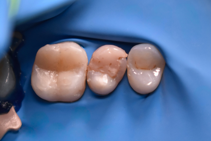 Restauración extensa defectuosa y caries secundaria del caso complejo