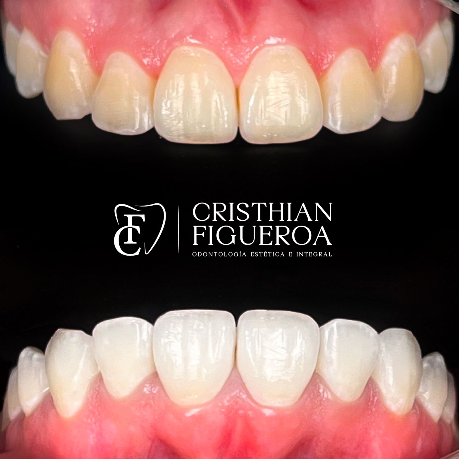 ¿El blanqueamiento dental daña los dientes? - Tratamiento de estética dental realizado por el Dr. Cristhian Figueroa, especialista en odontología estética en Bucaramanga
